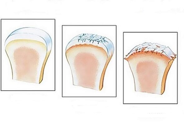 joint damage at different stages of the development of osteoarthritis