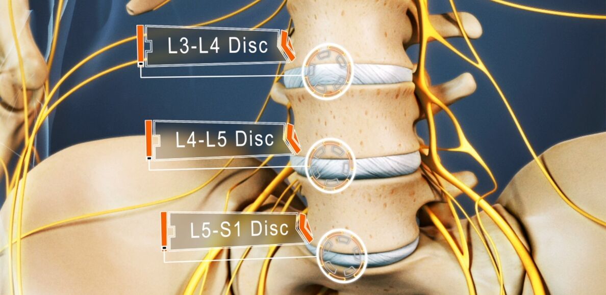 Lumbar discs most commonly affected in osteochondrosis