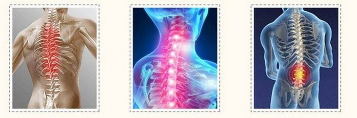 osteochondrosis of a different spine