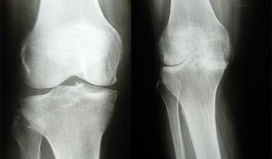Knee diagnostics methods