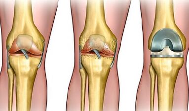The degree of development of knee arthrosis joint