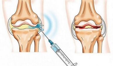 The knee -joint blockade for arthrosis