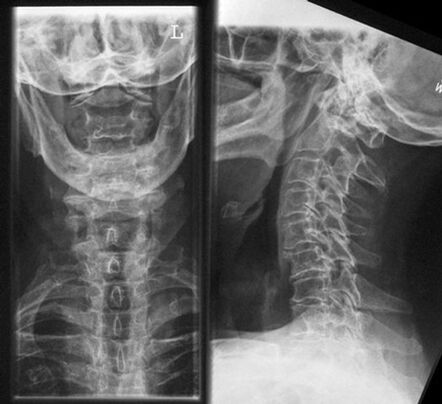 Cervica X -Ray - a method of diagnosing osteochondrosis