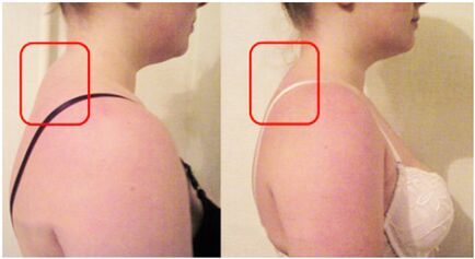 Formation of a muscle roller with cervical osteochondrosis