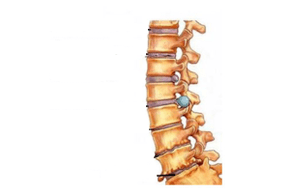 Spinal damage due to cervical osteochondrosis