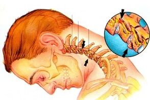Squeezing the nerve into the spine with cervical osteochondrosis