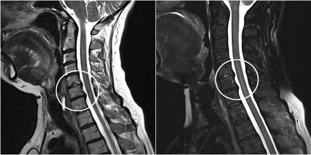 MRI of the cervical vertebrae