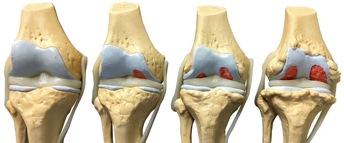 stages of arthrosis