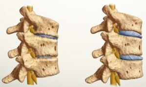 what does osteochondrosis look like