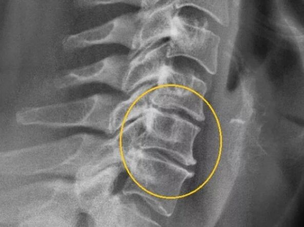 Osteochondrosis of the cervical vertebrae on an X-ray